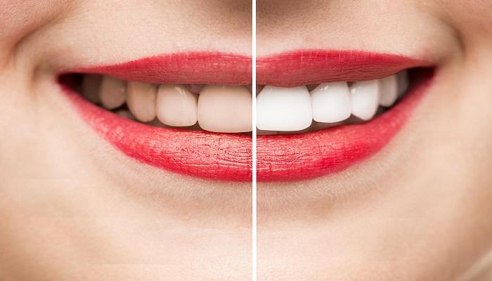 نصائح للحصول على أسنان بيضاء