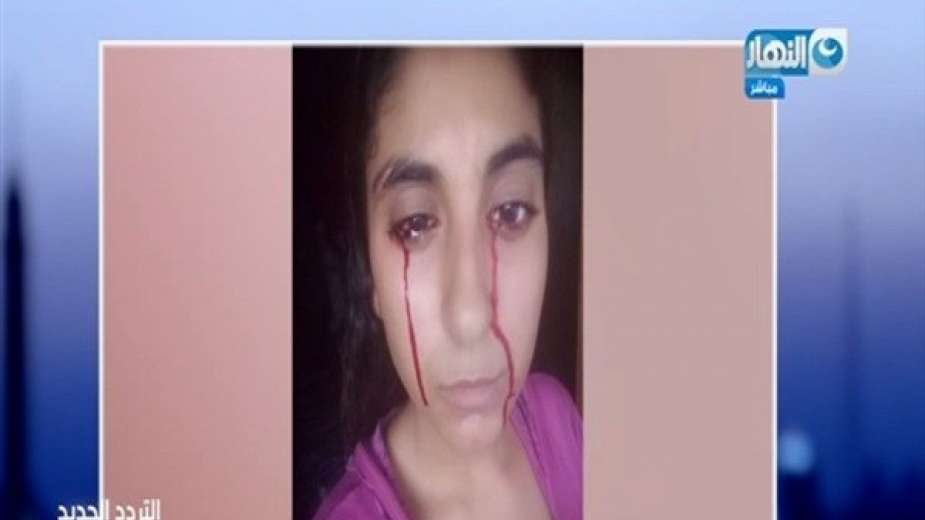 الأطباء عاجزون عن علاجها.. قصة فتاة يخرج الدم من عينيها وفمها وأنفها