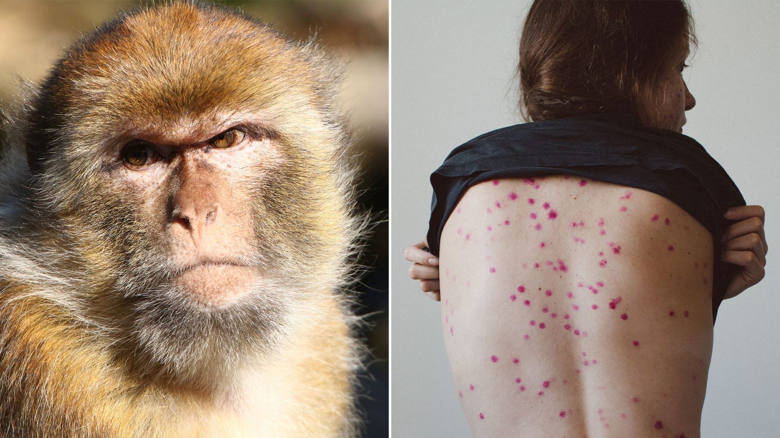 الكشف عن عدد المصابين بـ”جدري القرود” في العالم والفئات الأكثر عرضة للإصابة